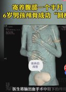 6岁男童颅骨寄养腹部1个半月 男童身体状况日渐好转