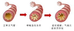 社区分享 | 世界哮喘日，关于哮喘的知识，你应该了解→