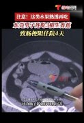 男子连吃三根生香蕉致肠梗阻 严重可引发肠梗阻