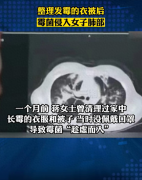 杭州姑娘清理发霉衣柜肺部长霉菌 这个有点吓人